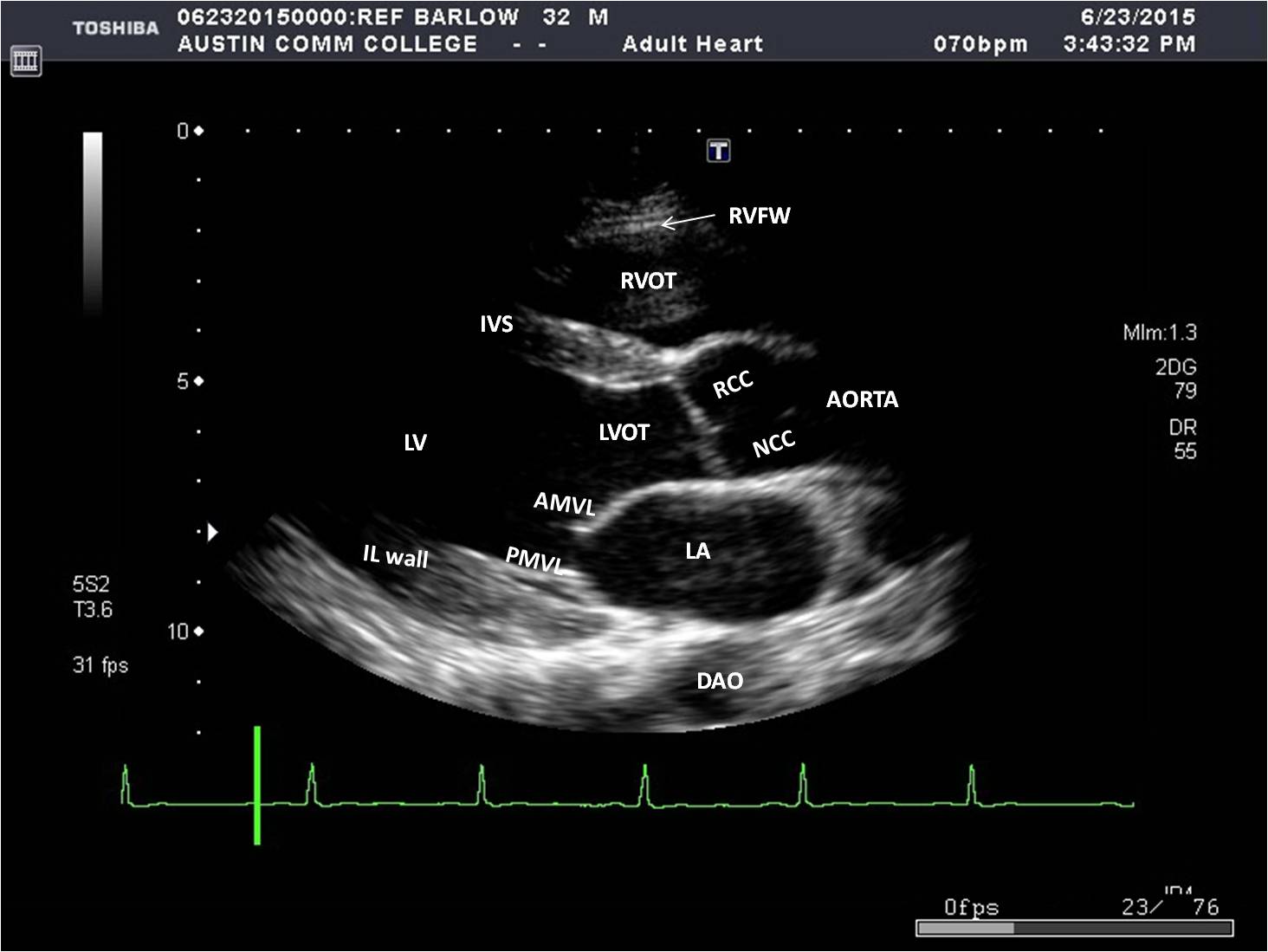 Parasternal Window Sonography Resources