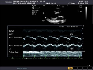 Parasternal Window | Sonography Resources