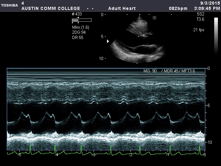 This M-mode spectrum is incorrect. The cursor does not transect the posterior mitral valve leaflet.