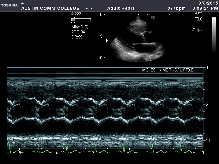 This M-mode spectrum is incorrect. The cursor does not transect the aortic valve closure line causing multiple linear echoes during diastole.